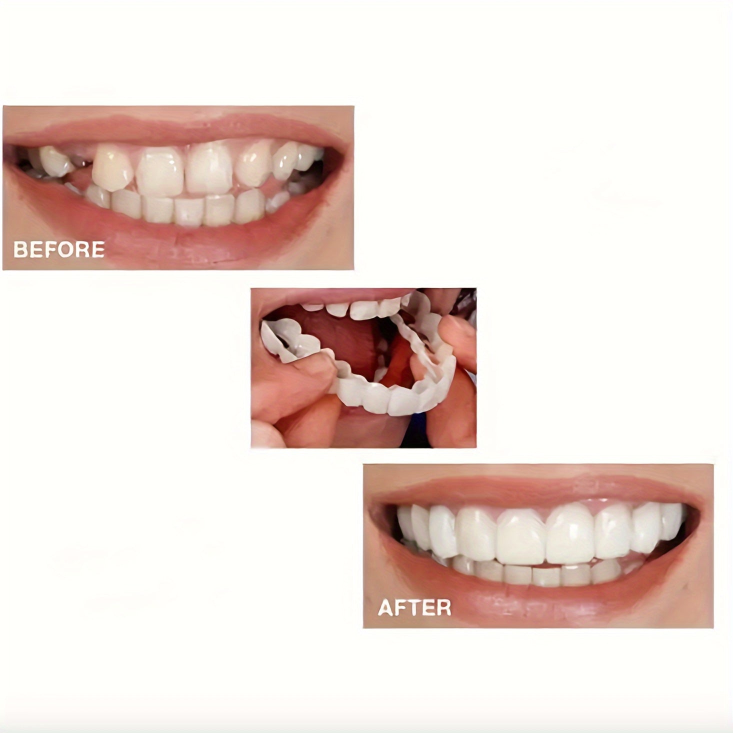 Dual Set Teeth Alignment Veneers